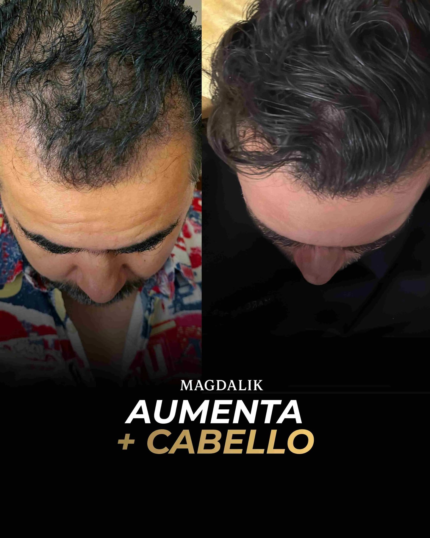 Kit ANTICAIDA + Cabello + Barba