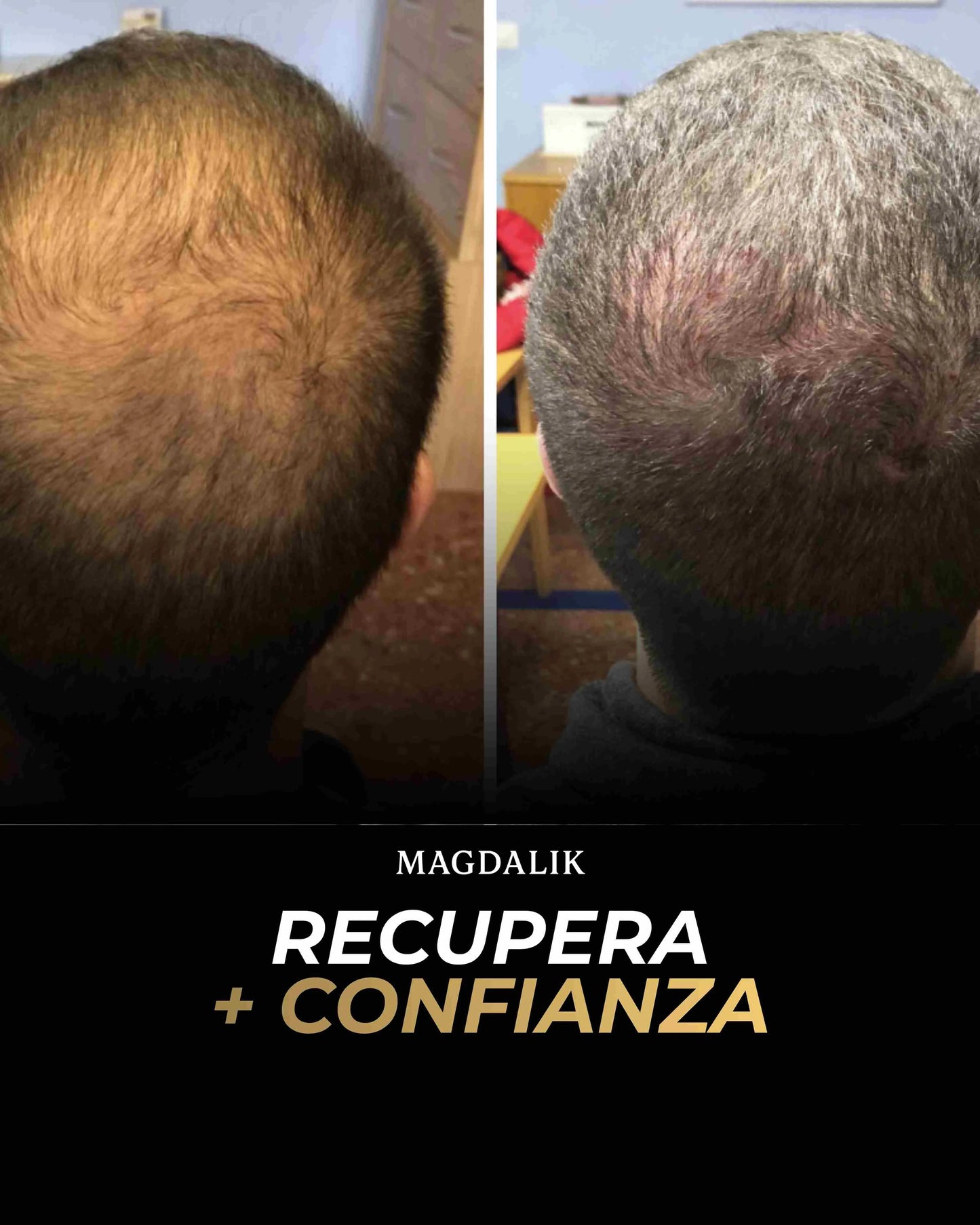 Kit ANTICAIDA + Cabello + Barba